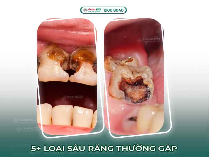 5 LOẠI RĂNG SÂU THƯỜNG GẶP VÀ CÁCH ĐIỀU TRỊ?