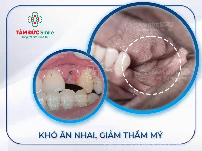 5 ẢNH HƯỞNG NGHIÊM TRỌNG KHI BỊ MẤT RĂNG VĨNH VIỄN VÀ GIẢI PHÁP HỮU HIỆU NHẤT