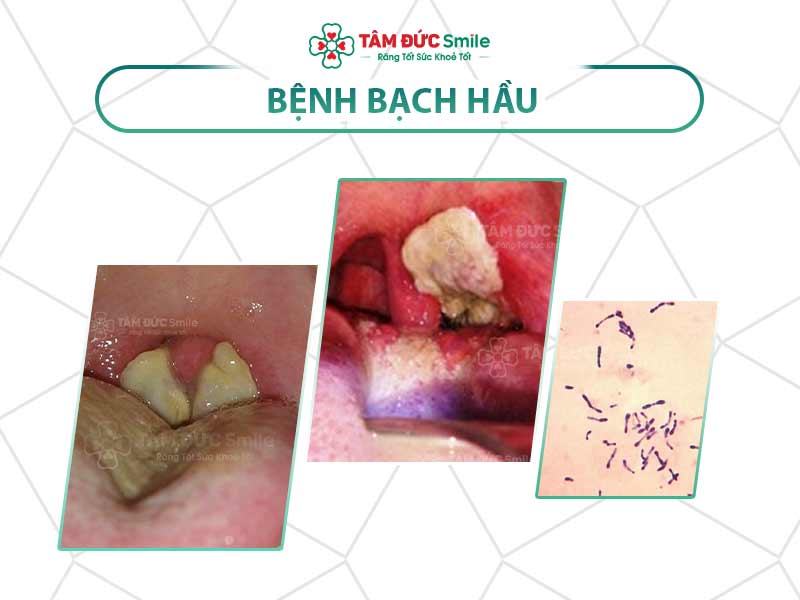 BẠCH HẦU LÀ BỆNH GÌ? BỆNH BẠCH HẦU CÓ CHỮA ĐƯỢC KHÔNG? CÁCH PHÒNG TRÁNH