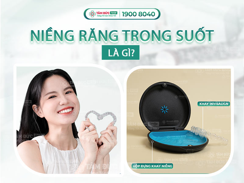 NIỀNG RĂNG TRONG SUỐT LÀ GÌ? BẢNG GIÁ NIỀNG RĂNG TRONG SUỐT