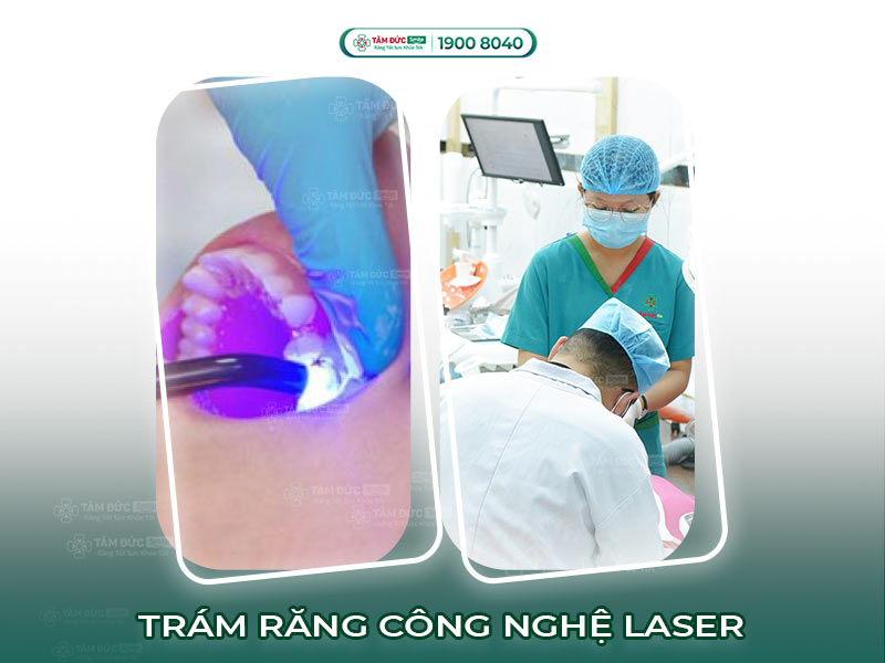 BẢNG GIÁ TRÁM RĂNG LASER TECH BAO NHIÊU TIỀN