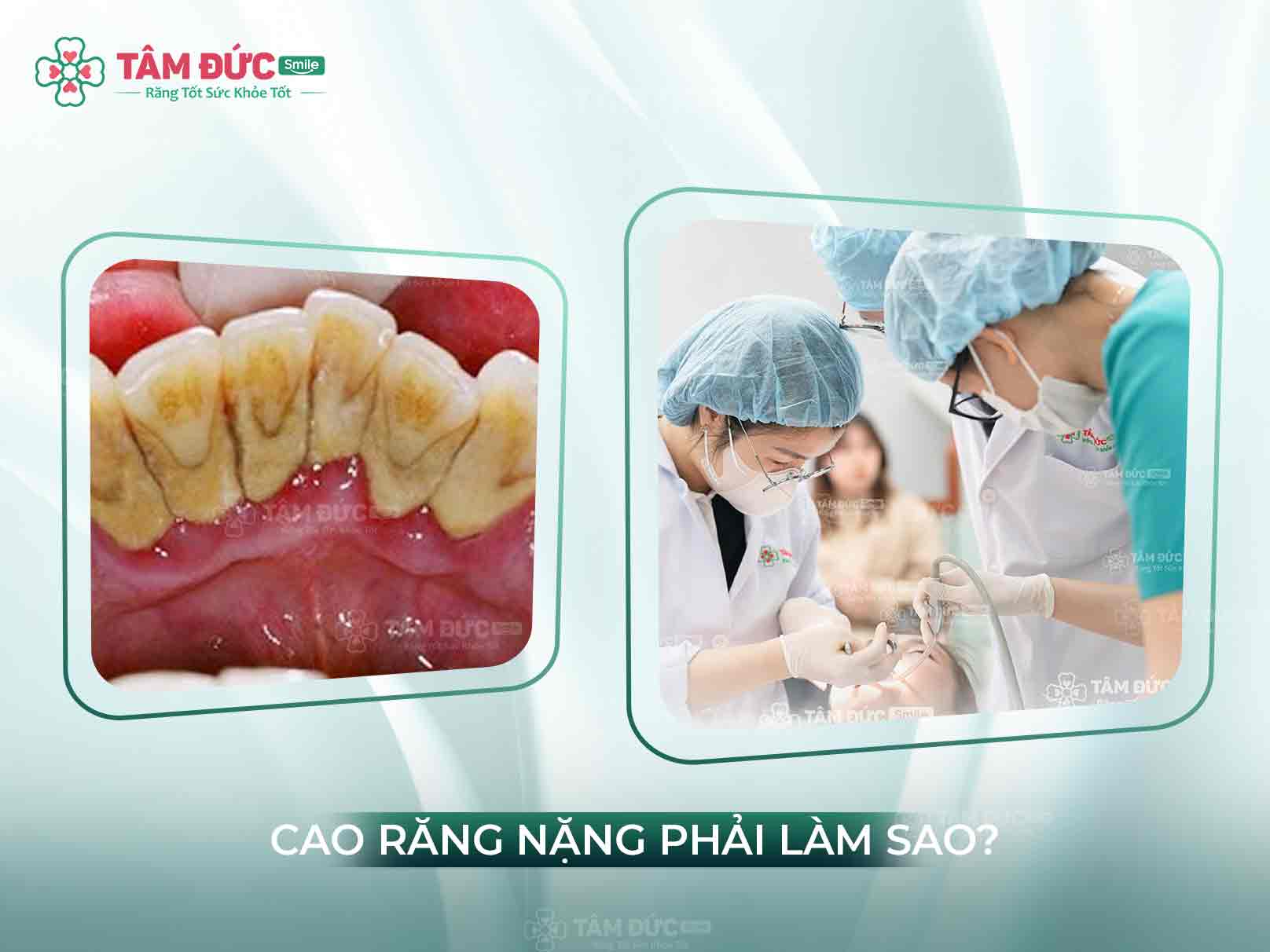 BỊ CAO RĂNG NẶNG NÊN ĐIỀU TRỊ VÀ PHÒNG NGỪA NHƯ THẾ NÀO?