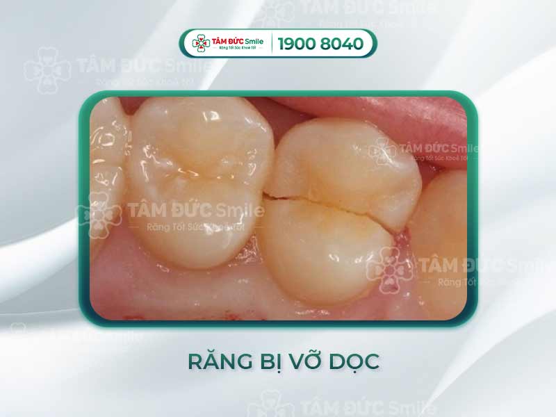 RĂNG BỊ VỠ DỌC LÀM SAO ĐỂ LÀNH LẠI? CÁCH CỨU RĂNG VỠ DỌC HIỆU QUẢ