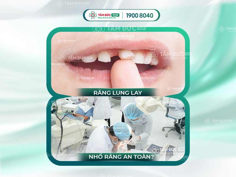 BỎ TÚI CÁCH NHỔ RĂNG LUNG LAY KHÔNG ĐAU AN TOÀN, HIỆU QUẢ