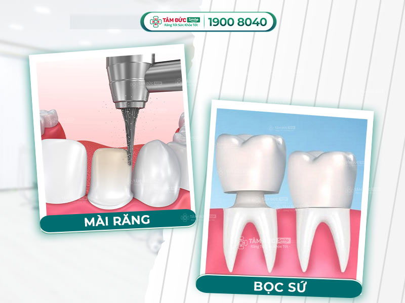 BỌC RĂNG SỨ KHÔNG MÀI CÓ KHẢ THI KHÔNG? THỰC CHẤT PHƯƠNG PHÁP NÀY LÀ GÌ?