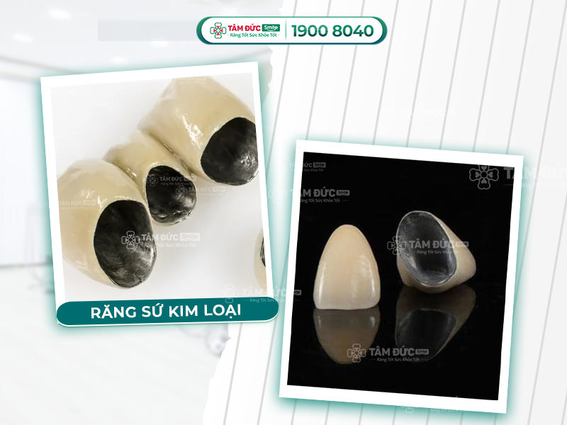 BỌC RĂNG SỨ KIM LOẠI GIÁ BAO NHIÊU TIỀN?