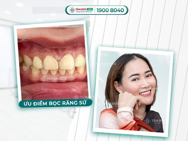 BỌC RĂNG SỨ THẨM MỸ CÓ TÁC HẠI GÌ KHÔNG?