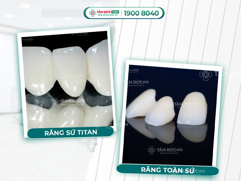 BỌC RĂNG SỨ TITAN CÓ NÊN HAY KHÔNG?