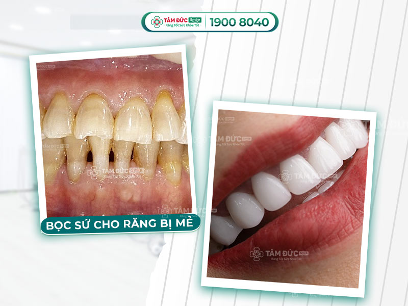 BỌC SỨ CHO RĂNG BỊ MẺ GIÁ BAO NHIÊU?