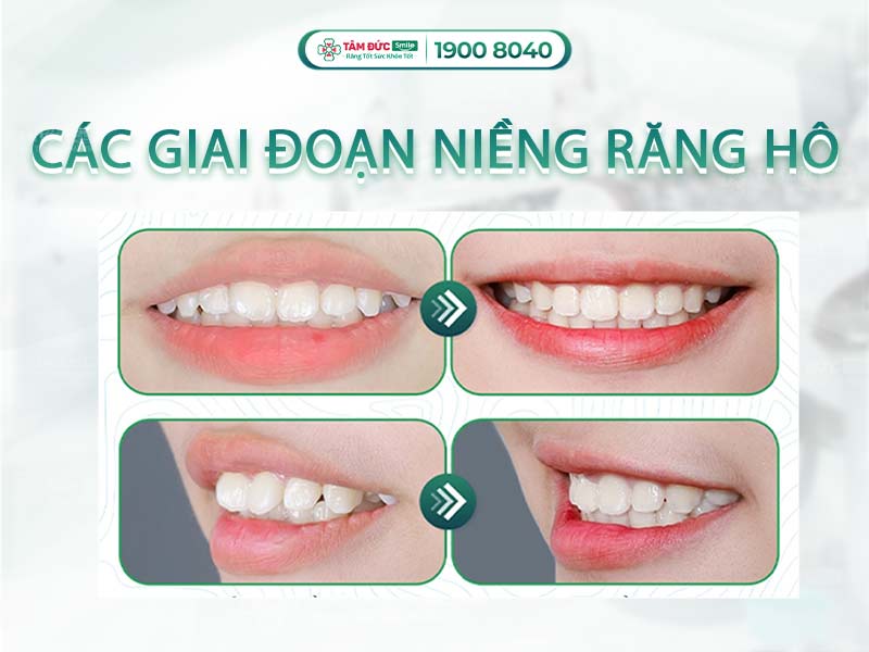 CÁC GIAI ĐOẠN NIỀNG RĂNG HÔ: CẨM NANG CHI TIẾT CHO NGƯỜI MỚI BẮT ĐẦU