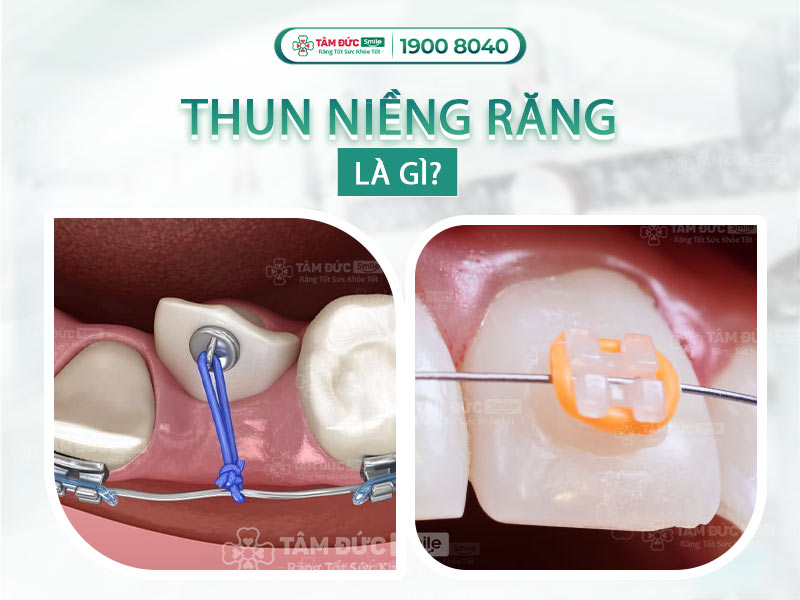 CÁC LƯU Ý QUAN TRỌNG TRONG QUÁ TRÌNH SỬ DỤNG THUN NIỀNG RĂNG