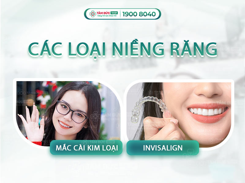 CÁC LOẠI NIỀNG RĂNG TỐT NHẤT HIỆN NAY 2025