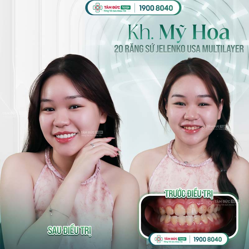 khách hàng làm răng phú quý tại nha khoa Tâm Đức Smile