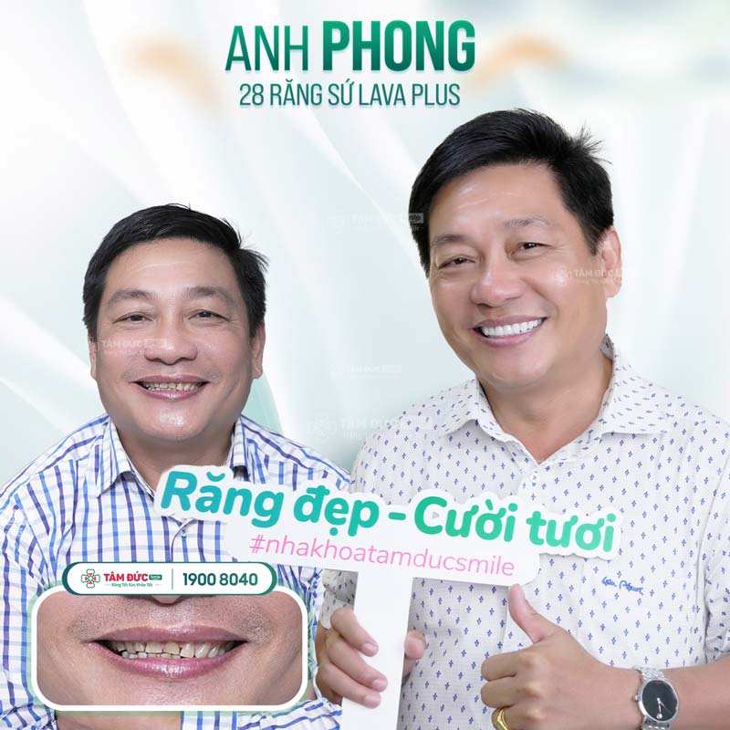 khách hàng làm bọc răng sứ phong thuỷ dáng răng rồng