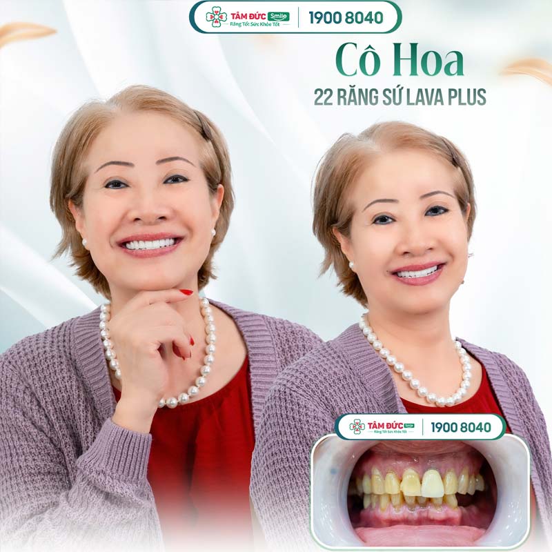 khách hàng làm răng phú quý tại nha khoa Tâm Đức Smile