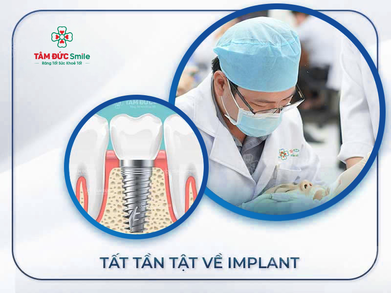 CẨM NANG TRỒNG RĂNG IMPLANT: 20+ LỜI GIẢI ĐÁP NHANH VỀ TRỒNG RĂNG IMPLANT