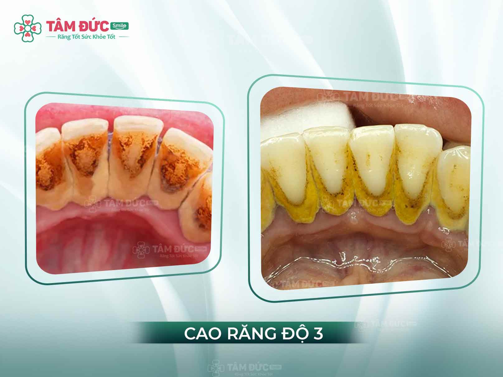 CAO RĂNG CẤP ĐỘ 3 NGUY HIỂM NHƯ THẾ NÀO? CÁCH XỬ LÝ HIỆU QUẢ