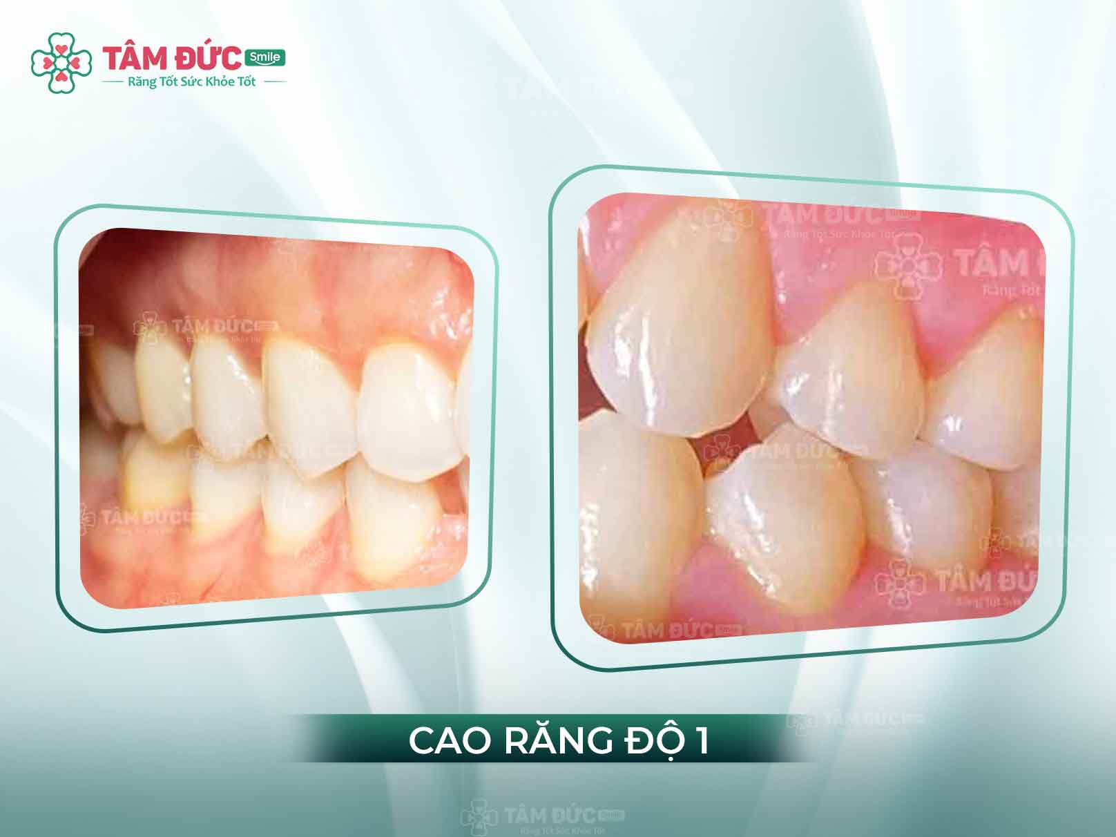 CAO RĂNG ĐỘ 1 - NHỮNG ẢNH HƯỞNG VÀ CÁCH LOẠI BỎ CAO RĂNG AN TOÀN