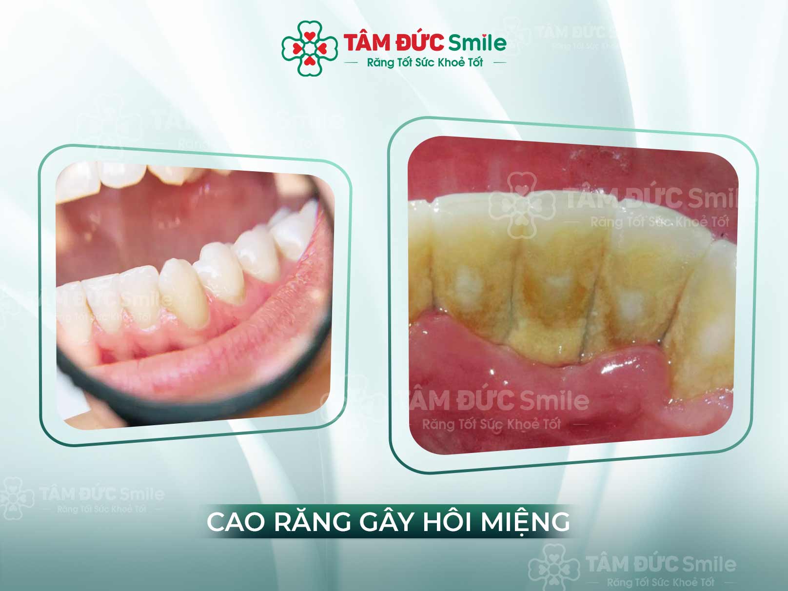 CAO RĂNG GÂY HÔI MIỆNG CÓ CHỮA ĐƯỢC KHÔNG?