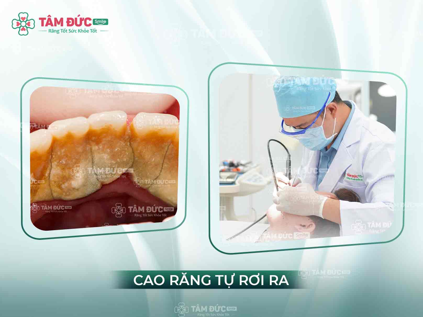 CAO RĂNG TỰ RƠI RA CÓ TỐT KHÔNG? CÁCH NGĂN NGỪA CAO RĂNG NGAY TẠI NHÀ