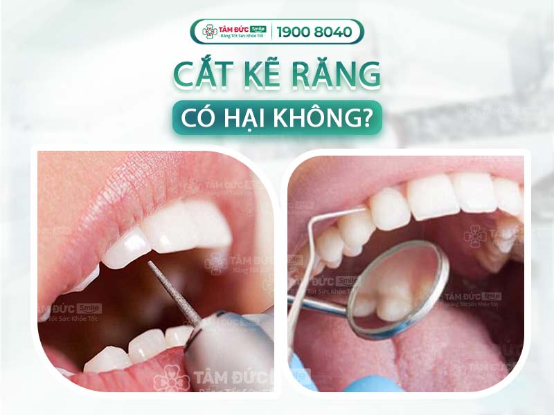   CẮT KẼ RĂNG CÓ HẠI KHÔNG? BÁC SĨ NHA KHOA GIẢI ĐÁP