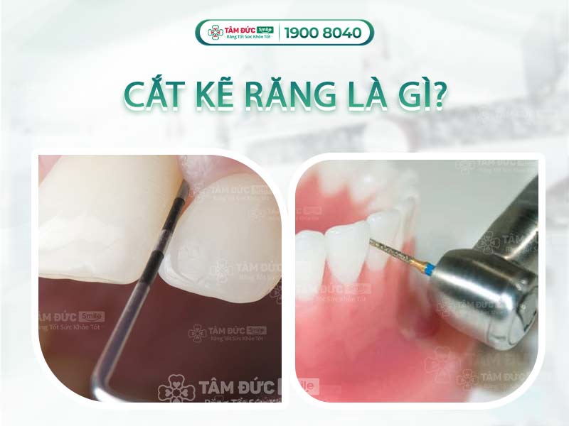 CẮT KẼ RĂNG LÀ GÌ? LỢI ÍCH VÀ QUY TRÌNH CẮT KẼ RĂNG NHƯ THẾ NÀO?