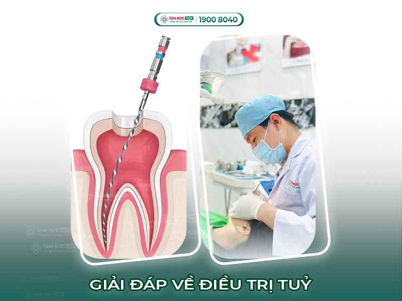 19+ CÂU HỎI VÀ GIẢI ĐÁP NHANH VỀ ĐIỀU TRỊ TỦY TẠI NHA KHOA TÂM ĐỨC SMILE