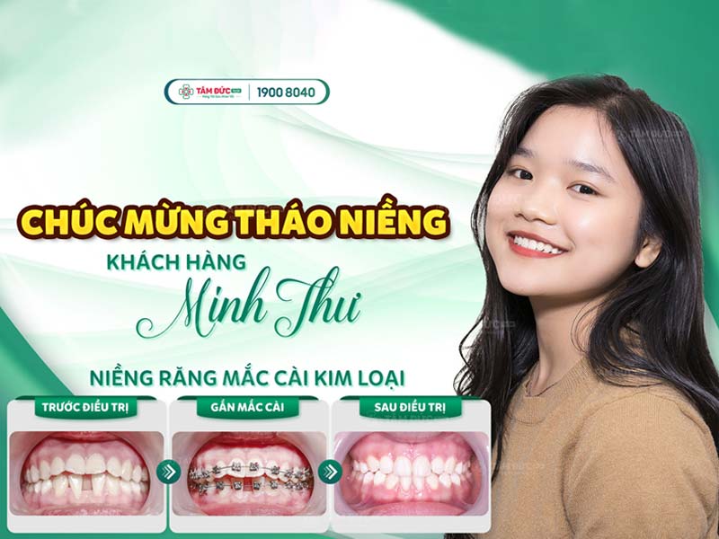 25+ CÂU HỎI VÀ GIẢI ĐÁP NHANH VỀ NIỀNG RĂNG TẠI NHA KHOA TÂM ĐỨC SMILE