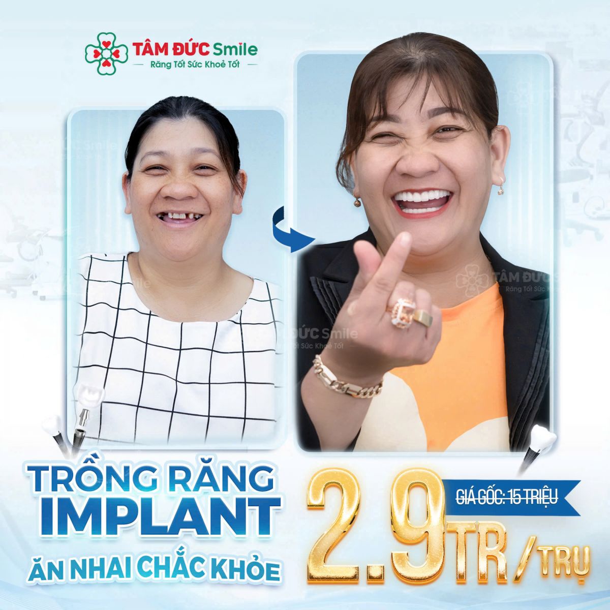 ƯU ĐÃI TRỒNG RĂNG IMPLANT CHỈ TỪ 2.9 TRIỆU/1 TRỤ