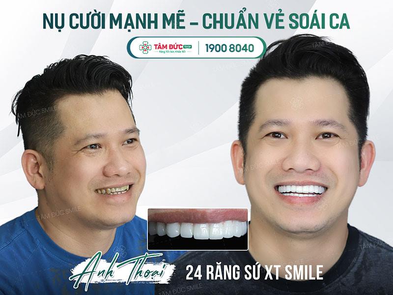 CERCON XT - ĐỘT PHÁ MỚI RĂNG TOÀN SỨ CERCON