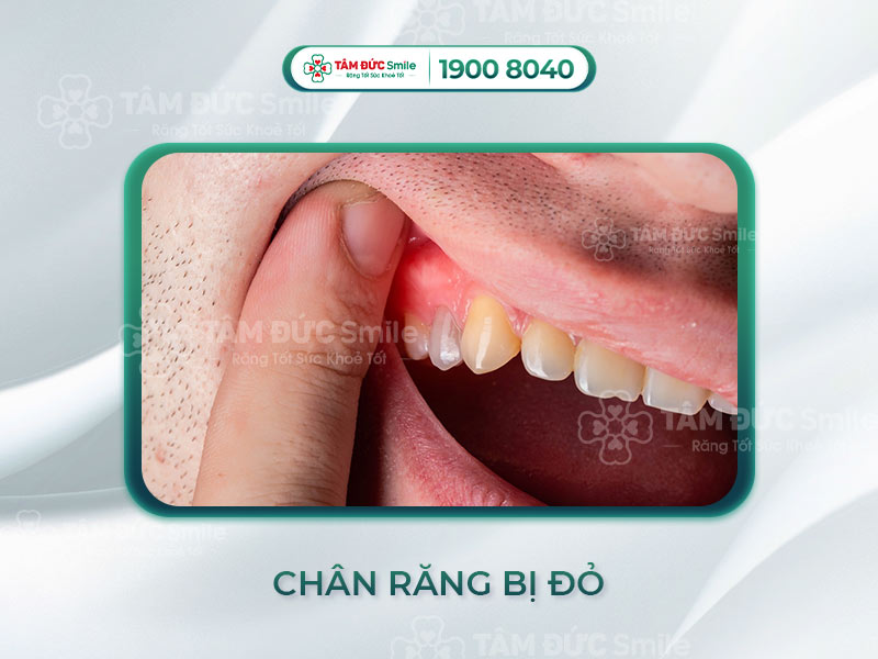 CHÂN RĂNG BỊ ĐỎ CÓ NGUY HIỂM KHÔNG? NGUYÊN NHÂN GÂY LÀ GÌ?