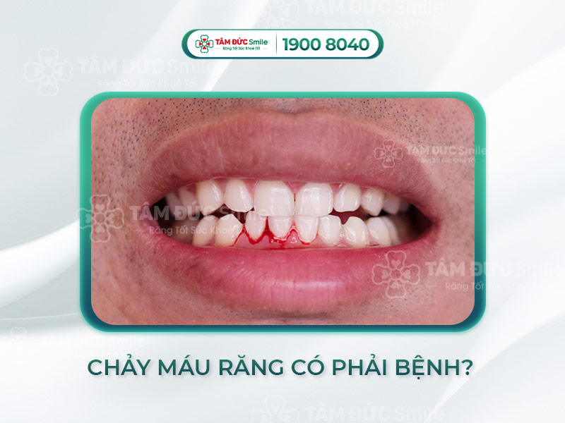 CHẢY MÁU RĂNG LÀ BỆNH GÌ? CÁCH PHÒNG NGỪA HIỆU QUẢ