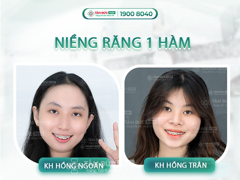 CHI PHÍ NIỀNG RĂNG 1 HÀM GIÁ BAO NHIÊU?