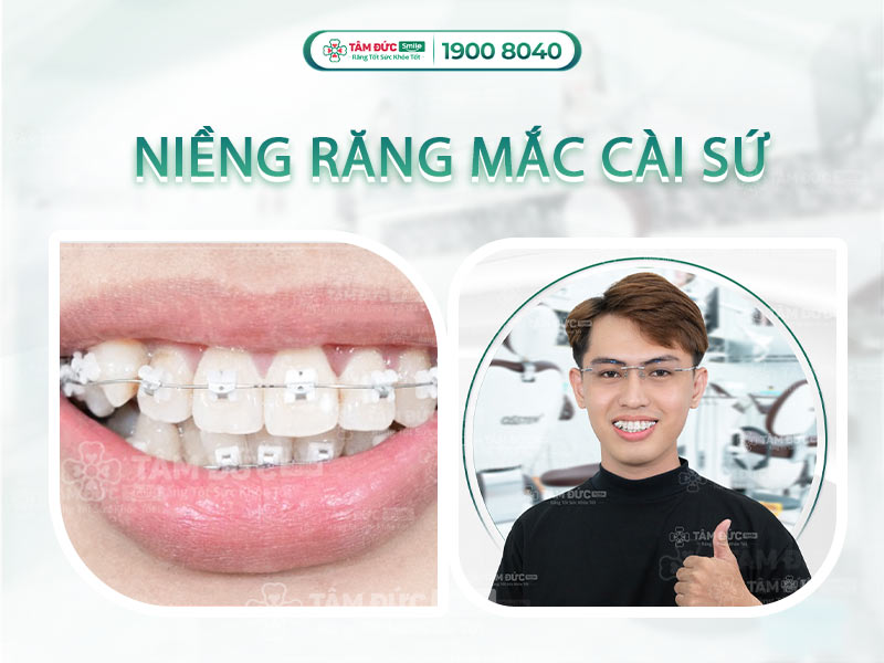 CHI PHÍ NIỀNG RĂNG MẮC CÀI SỨ GIÁ BAO NHIÊU?