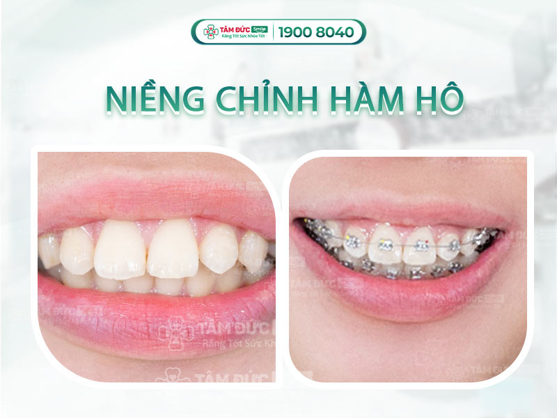 CHỈNH HÀM HÔ GIÁ BAO NHIÊU TIỀN?