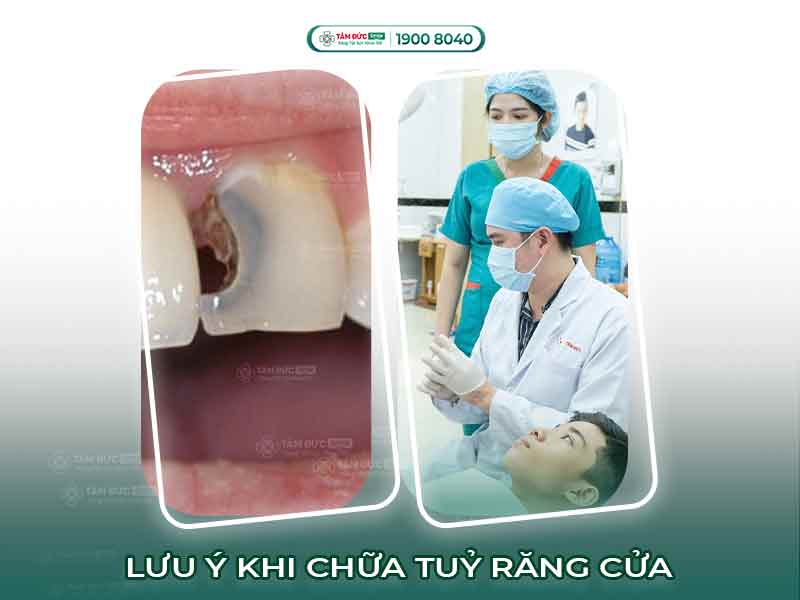 CHỮA TUỶ RĂNG CỬA: 5 LƯU Ý QUAN TRỌNG TRƯỚC VÀ SAU KHI THỰC HIỆN