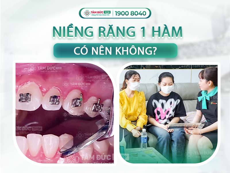 CÓ NÊN NIỀNG RĂNG HÀM TRÊN MÀ BỎ QUA HÀM DƯỚI KHÔNG?