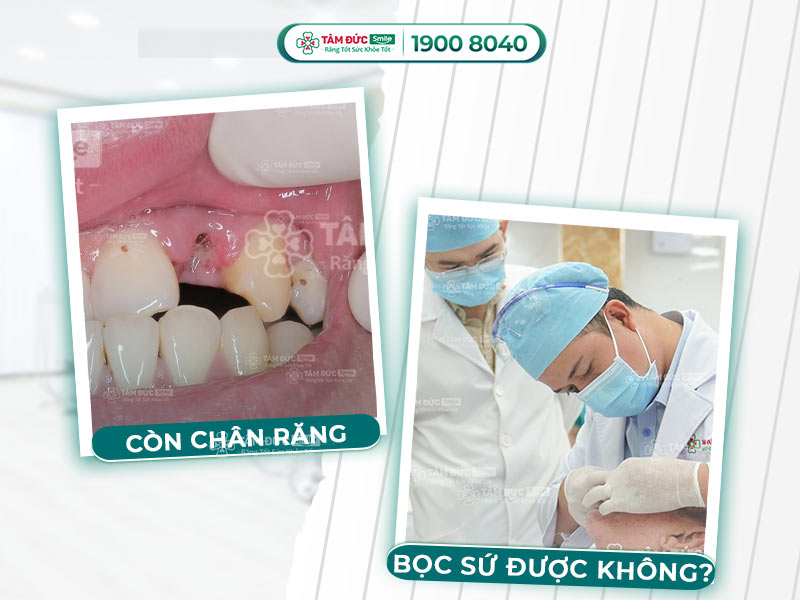 CÒN CHÂN RĂNG CÓ BỌC RĂNG SỨ ĐƯỢC KHÔNG? BẬT MÍ TỪ CHUYÊN GIA