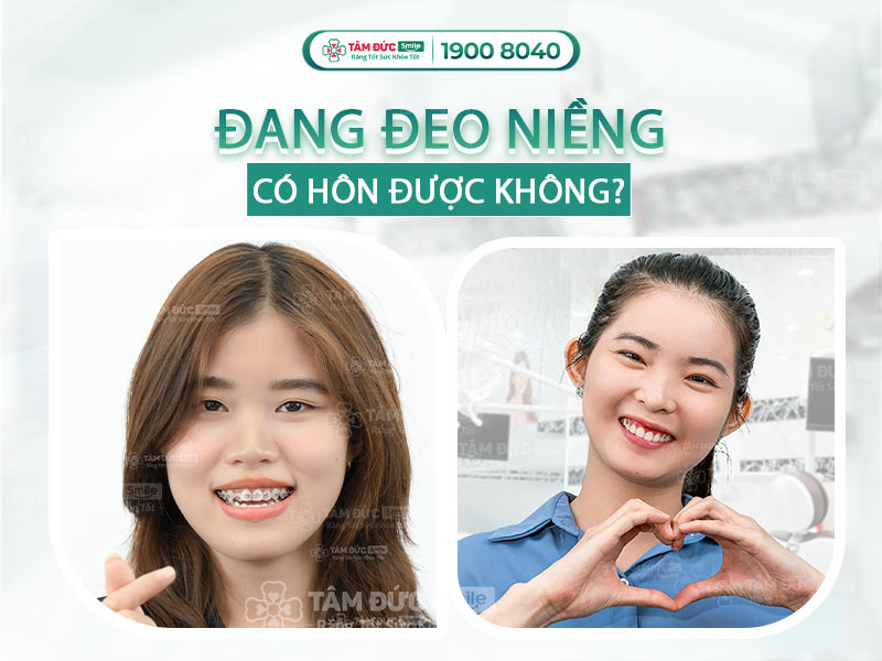 ĐANG ĐEO NIỀNG RĂNG CÓ HÔN ĐƯỢC KHÔNG? CẦN LƯU Ý NHỮNG GÌ?