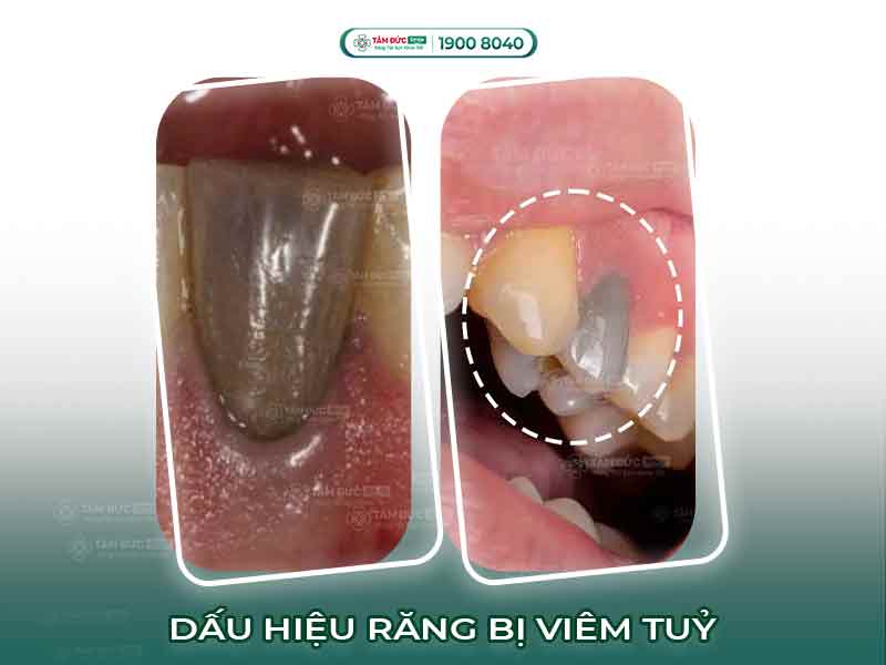 DẤU HIỆU CHO THẤY RĂNG ĐANG BỊ CHẾT TUỶ