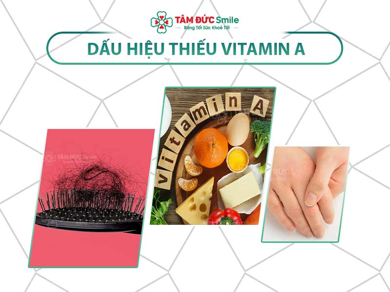 5+ DẤU HIỆU THIẾU VITAMIN A VÀ CÁCH BỔ SUNG HIỆU QUẢ