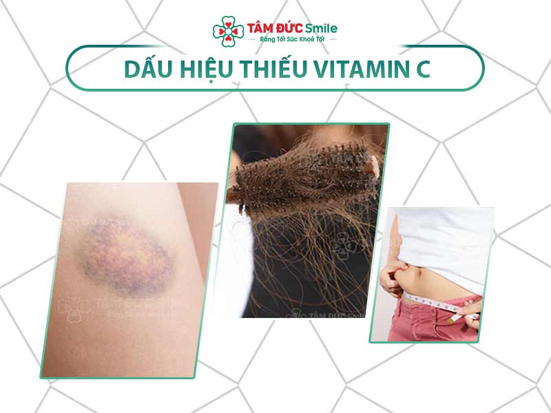 11+ DẤU HIỆU THIẾU VITAMIN C CẦN ĐẶC BIỆT LƯU Ý