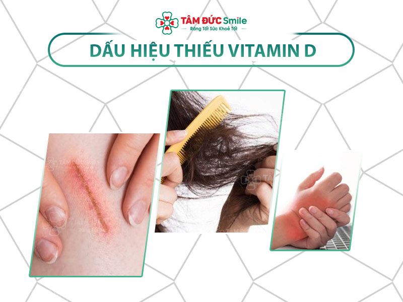 PHÁT HIỆN 11 DẤU HIỆU THIẾU VITAMIN D VÀ NHÓM THỰC PHẨM GIÀU VITAMIN D