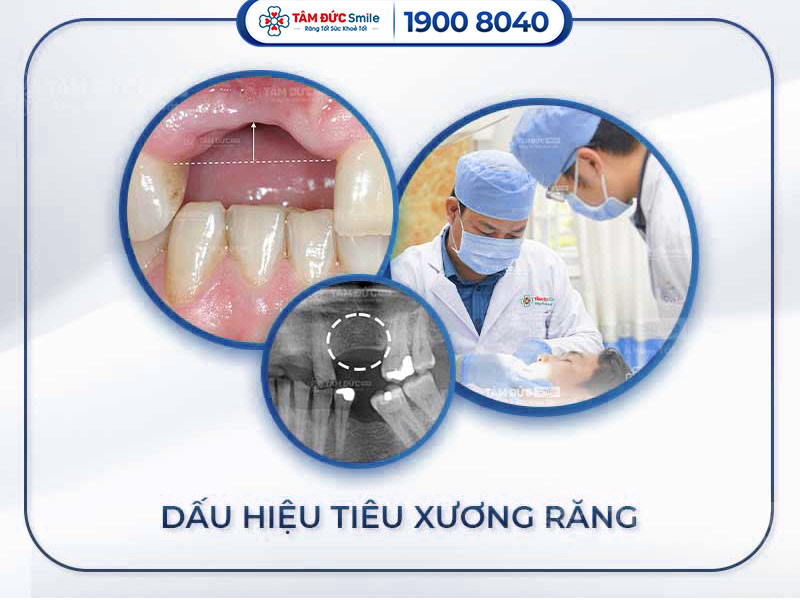 DẤU HIỆU TIÊU XƯƠNG RĂNG QUA TỪNG GIAI ĐOẠN