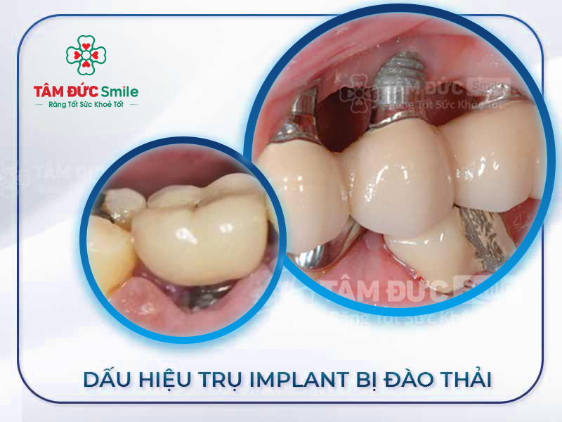 3+ DẤU HIỆU TRỤ IMPLANT BỊ ĐÀO THẢI VÀ CÁCH XỬ LÝ AN TOÀN