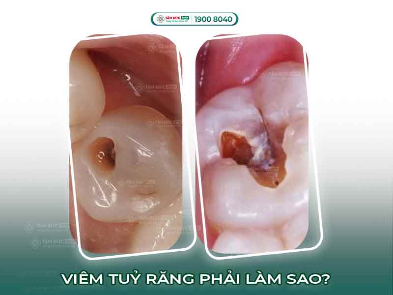 ĐAU TỦY RĂNG PHẢI LÀM SAO? TỦY RĂNG BỊ HỎNG CÓ TỰ LÀNH ĐƯỢC KHÔNG?