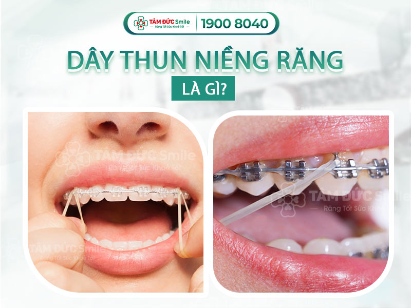 DÂY THUN NIỀNG RĂNG CÓ TÁC DỤNG GÌ? SỬ DỤNG THUN NIỀNG RĂNG ĐÚNG CÁCH