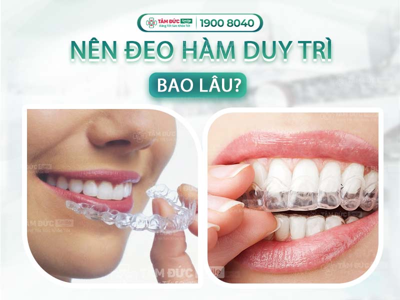 ĐEO HÀM DUY TRÌ BAO LÂU? BÍ QUYẾT GIỮ RĂNG THẲNG LÂU DÀI