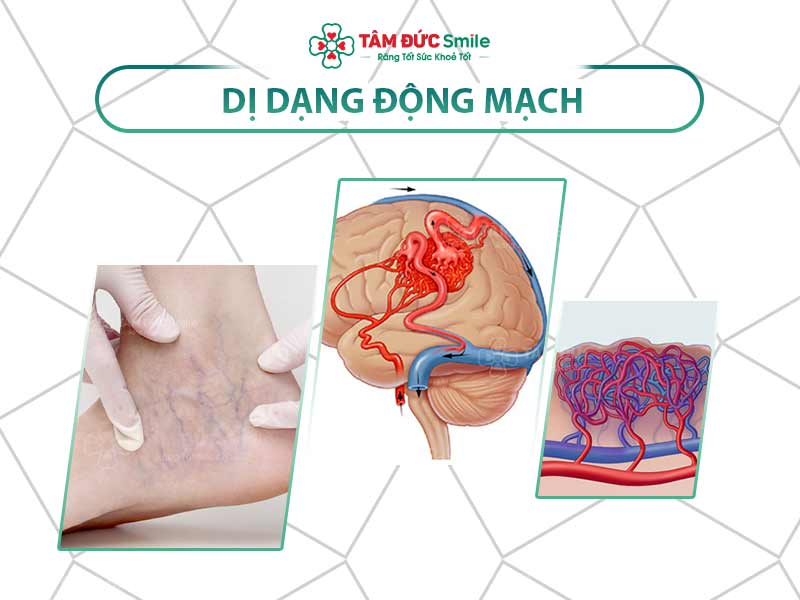 DỊ DẠNG MẠCH MÁU LÀ GÌ? DẤU HIỆU NHẬN BIẾT VÀ CÁCH PHÒNG NGỪA