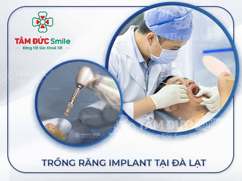 ĐỊA CHỈ TRỒNG RĂNG IMPLANT UY TÍN TẠI ĐÀ LẠT